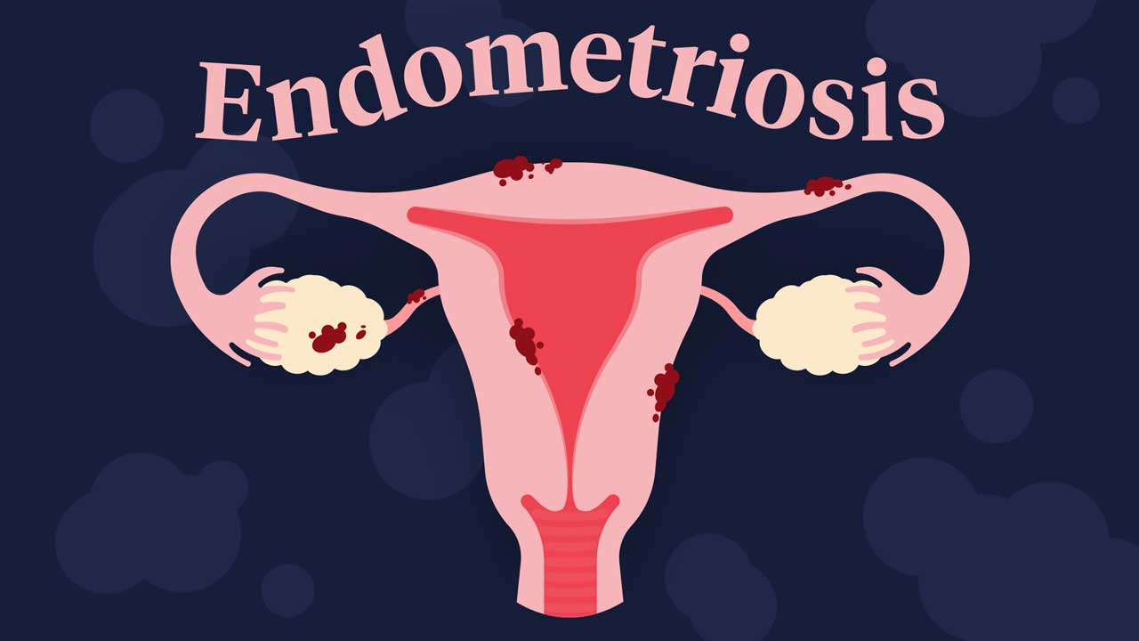 Best gynecologist for endometriosis in Jayanagar